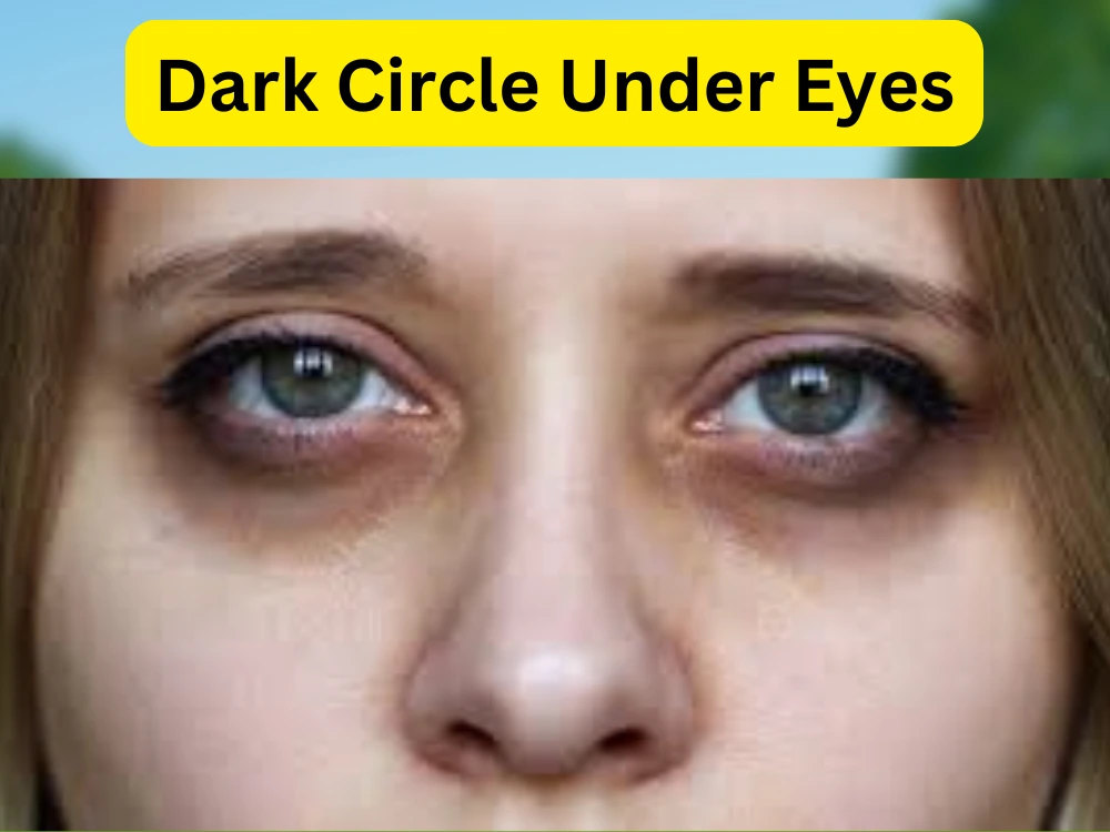 dark circle, under eyes, eye bags, circles